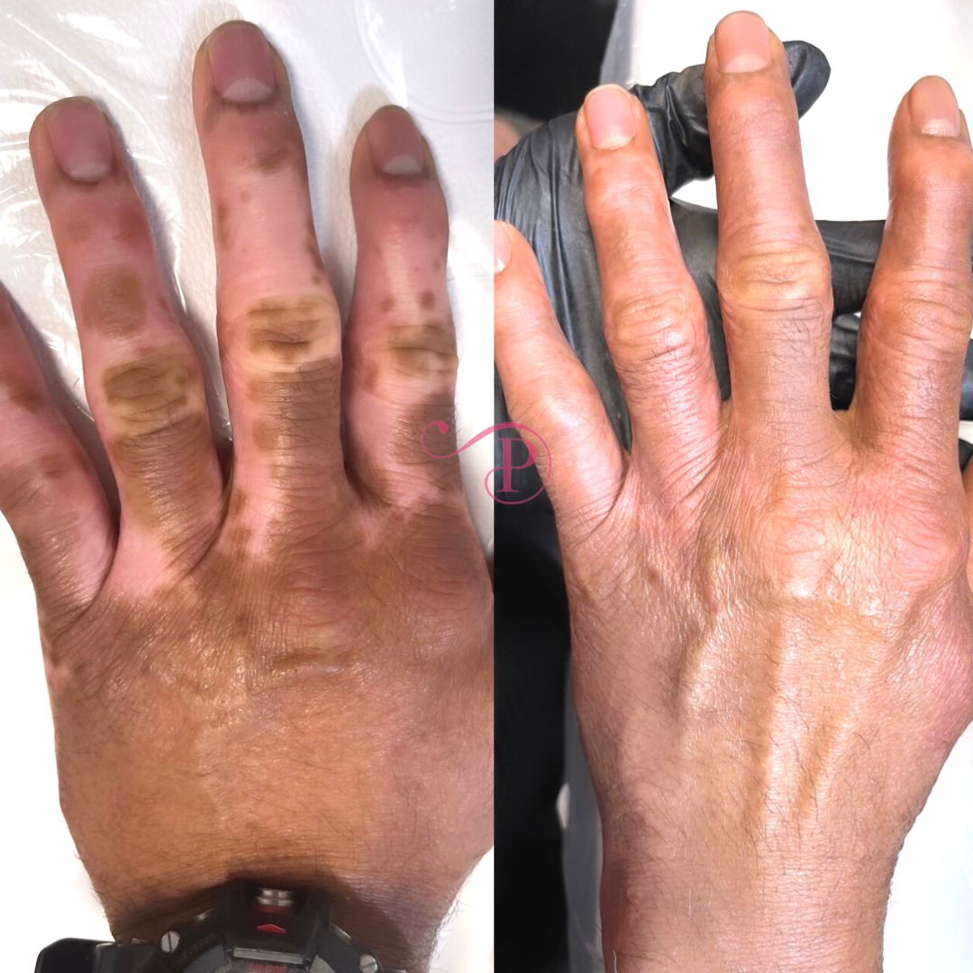 Skin and Scar Camouflage | Posh Beauty Permanent Makeup and Scar